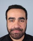 After Hair Transplant &nbsp;2 Sessions (Areas)